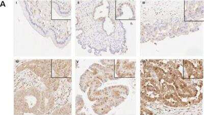 Immunohistochemistry-Paraffin: FoxM1 Antibody [NBP1-30961] - Representative images of immunoreactivity of nuclear FOXM1 in (I) benign cystadenoma, (II) borderline tumour, (III) stage I invasive cancer, (IV) stage II invasive cancer, (V) stage III invasive cancer and (VI) stage IV invasive cancer. Magnifications X400. Insets: Regions with higher magnifications of nuclear FOXM1 staining. Image collected and cropped by CiteAb from the following publication (dx.plos.org/10.1371/journal.pone.0113478), licensed under a CC-BY license.