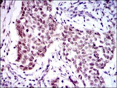 Immunohistochemistry: FoxP1 Antibody (6E4) [NBP2-37450] - Immunohistochemical analysis of paraffin-embedded breast cancer tissues using FOXP1 mouse mAb with DAB staining.