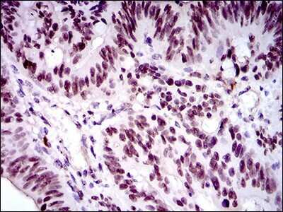 Immunohistochemistry: FoxP1 Antibody (6E4) [NBP2-37450] - Immunohistochemical analysis of paraffin-embedded rectum cancer tissues using FOXP1 mouse mAb with DAB staining.