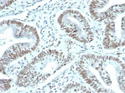 Immunohistochemistry-Paraffin: FoxP1 Antibody (FOXP1/44R) - Azide and BSA Free [NBP3-08470] - Formalin-fixed, paraffin-embedded human prostate carcinoma stained with FoxP1 Recombinant Rabbit Monoclonal Antibody (FoxP1/44R) [1ug/ml in PBS] for 30min RT. HIER: Tris/EDTA, pH9.0, 45min. 2 : HRP-polymer, 30min. DAB, 5min.