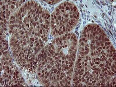 Immunohistochemistry: FoxP1 Antibody (OTI4F1) [NBP2-45713] - Analysis of Adenocarcinoma of Human ovary tissue.