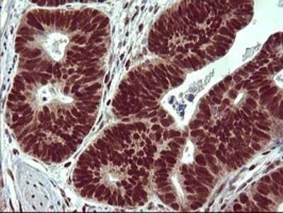 Immunohistochemistry: FoxP1 Antibody (OTI4F1) [NBP2-45713] - Analysis of Carcinoma of Human pancreas tissue.