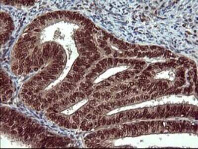 Immunohistochemistry: FoxP1 Antibody (OTI4F1) [NBP2-45713] - Analysis of Adenocarcinoma of Human endometrium tissue.