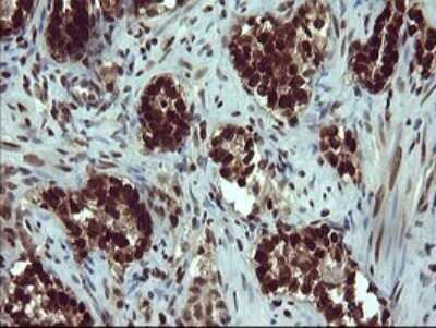 Immunohistochemistry: FoxP1 Antibody (OTI4F1) [NBP2-45713] - Analysis of Carcinoma of Human prostate tissue.