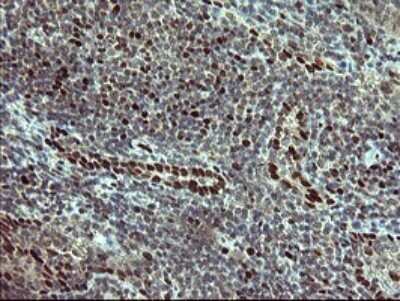 Immunohistochemistry: FoxP1 Antibody (OTI4F1) [NBP2-45713] - Analysis of Human lymphoma tissue.