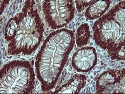 Immunohistochemistry: FoxP1 Antibody (OTI4F1) [NBP2-45713] - Analysis of Adenocarcinoma of Human colon tissue using FOXP1 mouse monoclonal antibody at 1:150