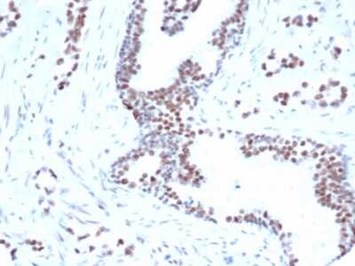 Immunohistochemistry-Paraffin: FoxP1 Antibody (rFOXP1/6902) [NBP3-13927] - Formalin-fixed, paraffin-embedded human prostate carcinoma stained with FoxP1 antibody (rFOXP1/6902) [1ug/ml in PBS] for 30min RT. HIER: Tris/EDTA, pH9.0, 45min. HRP-polymer, 30min. DAB, 5min