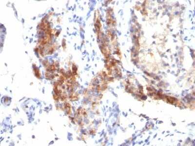 Immunohistochemistry-Paraffin: FoxP3 Antibody (SPM579) - Azide and BSA Free [NBP2-34432] - Formalin-fixed, paraffin-embedded human Testicular Carcinoma stained with FoxP3 Antibody (SPM579).