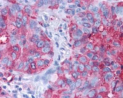 Immunohistochemistry-Paraffin: Frizzled-1 Antibody [NLS4150] - Analysis of anti-FZD1 / Frizzled 1 antibody with human lung, non-small cell carcinoma.