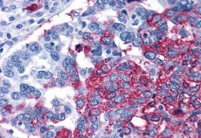 Immunohistochemistry-Paraffin: Frizzled-1 Antibody [NLS4150] - Human Ovary, Carcinoma. Immunohistochemistry of formalin-fixed, paraffin-embedded tissue after heat-induced antigen retrieval.