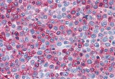 Immunohistochemistry-Paraffin: Frizzled-1 Antibody [NLS4150] - Human Lymph Node, Non-Hodgkins Lymphoma. Immunohistochemistry of formalin-fixed, paraffin-embedded tissue after heat-induced antigen retrieval.