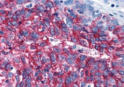 Immunohistochemistry-Paraffin: Frizzled-3 Antibody [NLS4437] - Analysis of anti-FZD3 / Frizzled 3 antibody with human ovary, carcinoma.