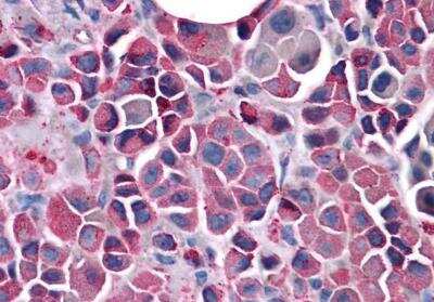 Immunohistochemistry-Paraffin: Frizzled-3 Antibody [NLS4437] - Analysis of anti-FZD3 / Frizzled 3 antibody with human skin, melanoma.