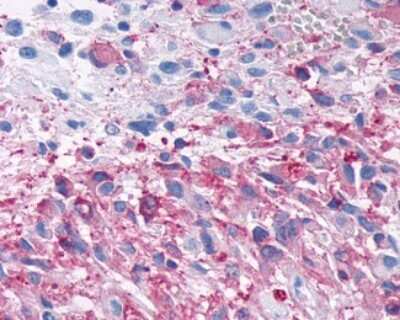 Immunohistochemistry-Paraffin: Frizzled-3 Antibody [NLS4454] - Analysis of anti-FZD3 / Frizzled 3 antibody with human brain, glioblastoma.