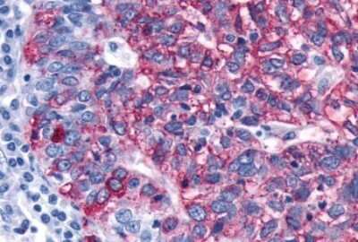 Immunohistochemistry-Paraffin: Frizzled-3 Antibody [NLS4454] - Anti-FZD3 / Frizzled 3 antibody IHC of human Ovary, Carcinoma. Immunohistochemistry of formalin-fixed, paraffin-embedded tissue after heat-induced antigen retrieval.