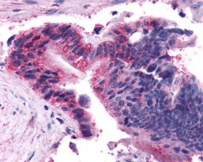 Immunohistochemistry-Paraffin: Frizzled-5 Antibody [NLS4273] - Analysis of anti-FZD5 / Frizzled 5 antibody with human colon, carcinoma.