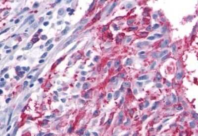 Immunohistochemistry-Paraffin: Frizzled-5 Antibody [NLS4284] - Anti-FZD5 / Frizzled 5 antibody IHC of human Skin, Melanoma. Immunohistochemistry of formalin-fixed, paraffin-embedded tissue after heat-induced antigen retrieval.