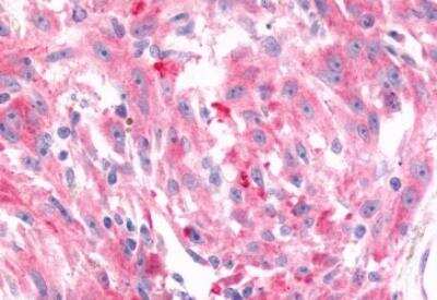 Immunohistochemistry-Paraffin: Frizzled-6 Antibody [NLS4482] - Human Skin, Melanoma. Immunohistochemistry of formalin-fixed, paraffin-embedded tissue after heat-induced antigen retrieval.