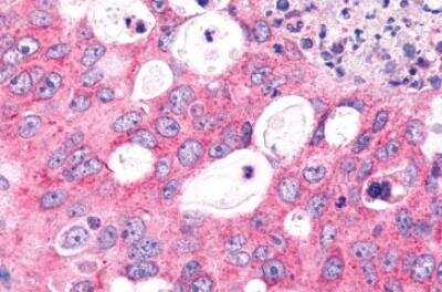 Immunohistochemistry-Paraffin: Frizzled-6 Antibody [NLS4482] - Human Lung, Non-Small Cell Carcinoma. Immunohistochemistry of formalin-fixed, paraffin-embedded tissue after heat-induced antigen retrieval.