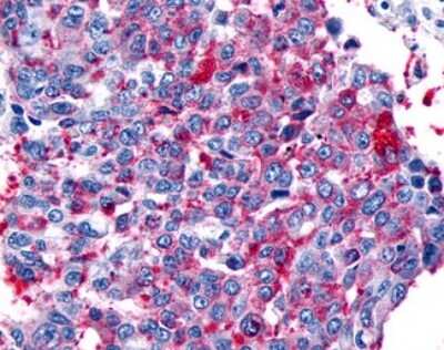 Immunohistochemistry-Paraffin: Frizzled-8 Antibody [NLS4766] - Analysis of anti-FZD8 / Frizzled 8 antibody with human lung, non-small cell carcinoma.