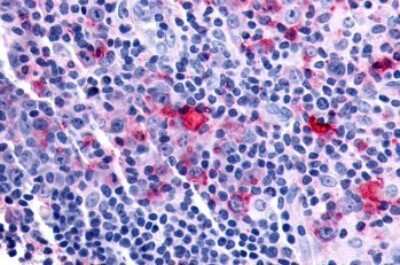 Immunohistochemistry-Paraffin: Frizzled-8 Antibody [NLS4766] - Anti-FZD8 / Frizzled 8 antibody IHC of human Lymph Node, Hodgkins Lymphoma. Immunohistochemistry of formalin-fixed, paraffin-embedded tissue after heat-induced antigen retrieval.