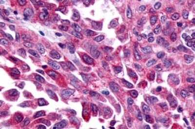 Immunohistochemistry-Paraffin: Frizzled-8 Antibody [NLS4776] - Anti-FZD8 / Frizzled 8 antibody IHC of human Lung, Non-Small Cell Carcinoma. Immunohistochemistry of formalin-fixed, paraffin-embedded tissue after heat-induced antigen retrieval.