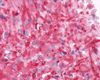 Immunohistochemistry-Paraffin: Frizzled-9 Antibody [NLS5097] - Analysis of anti-FZD9 / Frizzled 9 antibody with human brain, glioblastoma.