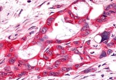 Immunohistochemistry-Paraffin: Frizzled-9 Antibody [NLS5103] - Anti-FZD9 / Frizzled 9 antibody IHC of human Pancreas, Carcinoma. Immunohistochemistry of formalin-fixed, paraffin-embedded tissue after heat-induced antigen retrieval.