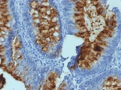 Immunohistochemistry-Paraffin: Fucosyltransferase 3/FUT3 Antibody (SPM194) - Azide and BSA Free [NBP2-47928] - Formalin-fixed, paraffin-embedded human Colon Carcinoma stained with Fucosyltransferase 3/FUT3 Antibody (SPM194).