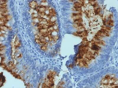 Immunohistochemistry-Paraffin: Fucosyltransferase 3/FUT3 Antibody (SPM194) [NBP2-44597] - Formalin-fixed, paraffin-embedded human Colon Carcinoma stained with Fucosyltransferase 3/FUT3 Antibody (SPM194).