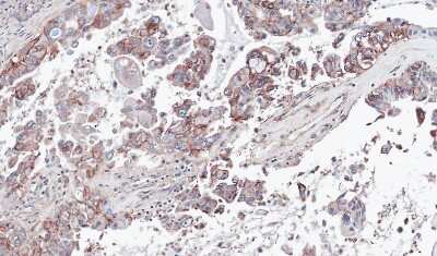 Immunohistochemistry-Paraffin: G protein alpha Antibody [NBP1-31405] - Paraffin-embedded OVCA, using antibody at 1:100 dilution.