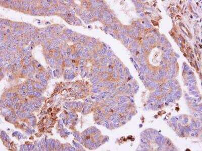 Immunohistochemistry-Paraffin: G protein alpha inhibitor 1 Antibody [NBP1-31601] - Paraffin-embedded colon carcinoma. G protein alpha Inhibitor 1 antibody dilution: 1:500.