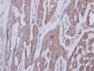 Immunohistochemistry-Paraffin: G protein alpha inhibitor 1 Antibody [NBP2-16558] - human breast cancer, using G protein alpha Inhibitor 1 antibody at 1:250 dilution. Antigen Retrieval: Trilogy™ (EDTA based, pH 8.0) buffer, 15min. 