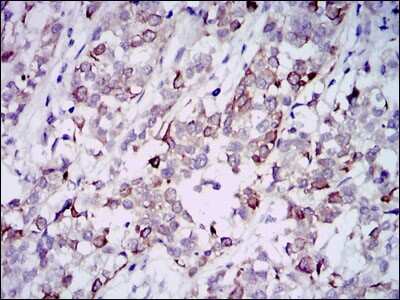 Immunohistochemistry-Paraffin: GAB1 Antibody (1A7) [NBP2-37742] - Analysis of bladder cancer tissues using GAB1 mouse mAb with DAB staining.