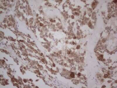 Immunohistochemistry: GABA-AR alpha 5 Antibody (OTI1G9) - Azide and BSA Free [NBP2-70789] - Analysis of Carcinoma of Human lung tissue.(Heat-induced epitope retrieval by Tris-EDTA, pH8.0) .