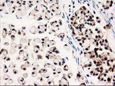 Immunohistochemistry: GALE Antibody (OTI1C4) - Azide and BSA Free [NBP2-70793] - Staining of paraffin-embedded Adenocarcinoma of Human colon tissue using anti-GALE mouse monoclonal antibody.