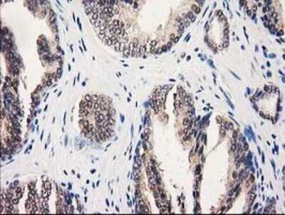 Immunohistochemistry: GALE Antibody (OTI1C4) - Azide and BSA Free [NBP2-70793] - Staining of paraffin-embedded Carcinoma of Human prostate tissue using anti-GALE mouse monoclonal antibody.