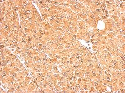 Immunohistochemistry-Paraffin: GALM Antibody [NBP2-16593] - Antibody detects GALM protein at cytosol on U87 xenograft by immunohistochemical analysis. Sample: Paraffin-embedded U87 xenograft. GALM antibody dilution: 1:500.