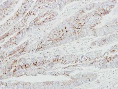 Immunohistochemistry-Paraffin: GALNT2 Antibody [NBP1-32394] - Paraffin-embedded Colon ca, using antibody at 1:250 dilution.