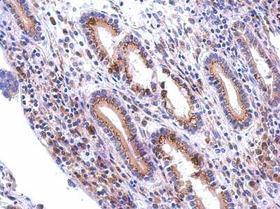 Immunohistochemistry-Paraffin: GALNT7 Antibody [NBP2-16597] - Immunohistochemical analysis of paraffin-embedded gastric ca, using antibody at 1:500 dilution.