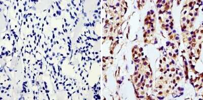 Immunohistochemistry-Paraffin: GAPDH Antibody (GA1R) [NBP2-37828] - Analysis showing staining in the nucleus and cytoplasm of paraffin-embedded human breast carcinoma (right) compared with a negative control without primary antibody (left).