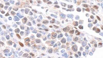 Immunohistochemistry: GAPDH Antibody [NB300-326] - Detection of mouse GAPDH by immunohistochemistry. Sample: FFPE section of mouse plasmacytoma. Antibody: Affinity purified rabbit anti-GAPDH (NB300-326). Detection: DAB