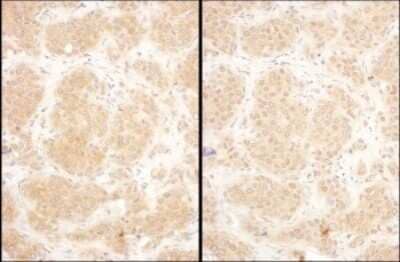 Immunohistochemistry: GART Antibody [NBP2-32206] - Samples: FFPE serial sections of human breast carcinoma. Antibody: Affinity purified rabbit anti- GART used at a dilution of 1:1,000 (1ug/ml). Detection: DAB. Counterstain: IHC Hematoxylin (blue).