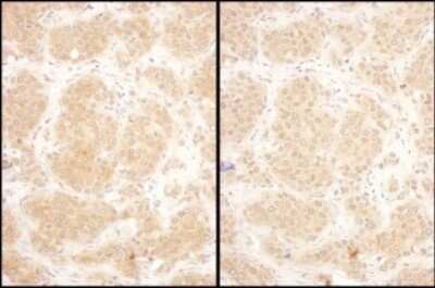 <b>Biological Strategies Validation. </b>Immunohistochemistry: GART Antibody [NBP2-32207] - Samples: FFPE serial sections of human breast carcinoma. Antibody: Affinity purified rabbit anti- GART used at a dilution of 1:1,000 (1ug/ml). Detection: DAB. Counterstain: IHC Hematoxylin (blue).