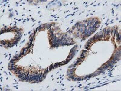 Immunohistochemistry-Paraffin: GAS7 Antibody (2F6) [NBP2-03061] - Staining of paraffin-embedded Adenocarcinoma of Human endometrium tissue using anti-GAS7 mouse monoclonal antibody.