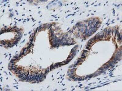Immunohistochemistry: GAS7 Antibody (OTI2F6) - Azide and BSA Free [NBP2-71376] - Staining of paraffin-embedded Adenocarcinoma of Human endometrium tissue using anti-GAS7 mouse monoclonal antibody.