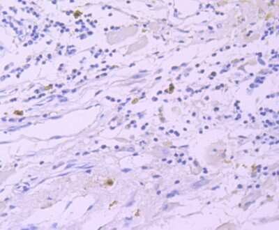 Immunohistochemistry-Paraffin: GATA-1 Antibody (JA10-32) [NBP2-66862] - Analysis of paraffin-embedded human breast cancer tissue using anti-GATA1 antibody. Counter stained with hematoxylin.