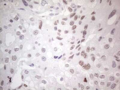 Immunohistochemistry: GATA-3 Antibody (OTI8H4) - Azide and BSA Free [NBP2-70796] - Analysis of Adenocarcinoma of Human breast tissue. (Heat-induced epitope retrieval by 1mM EDTA in 10mM Tris buffer (pH8.5) at 120C for 3 min)