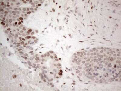 Immunohistochemistry: GATA-3 Antibody (OTI8H4) - Azide and BSA Free [NBP2-70796] - Analysis of Adenocarcinoma of Human endometrium tissue. (Heat-induced epitope retrieval by 1mM EDTA in 10mM Tris buffer (pH8.5) at 120C for 3 min)