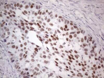 Immunohistochemistry: GATA-3 Antibody (OTI8H4) - Azide and BSA Free [NBP2-70796] - Analysis of Carcinoma of Human kidney tissue. (Heat-induced epitope retrieval by 1mM EDTA in 10mM Tris buffer (pH8.5) at 120C for 3 min)